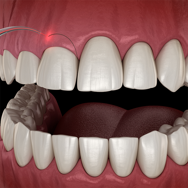 Illustration of a laser treating a gummy smile