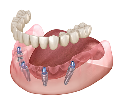 Illustration of an implant denture