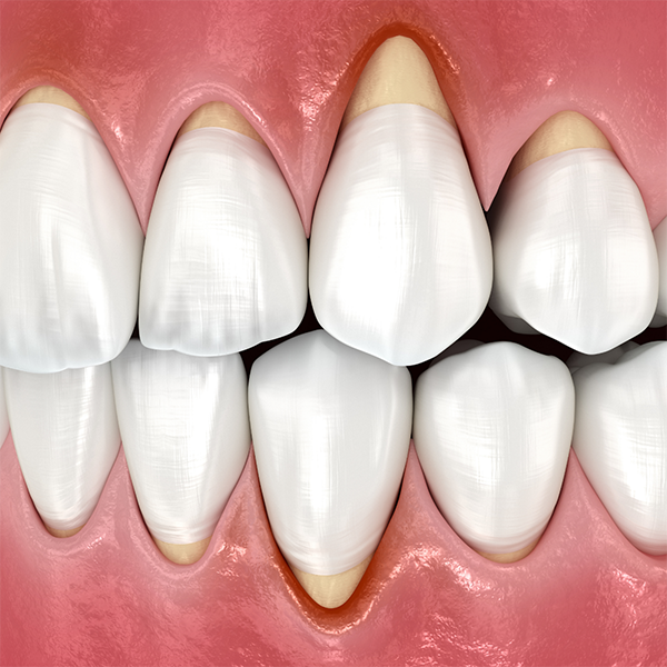 Illustration of receding gums