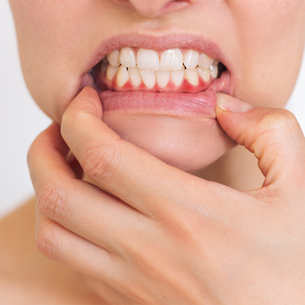 Close-up of a person with red gums