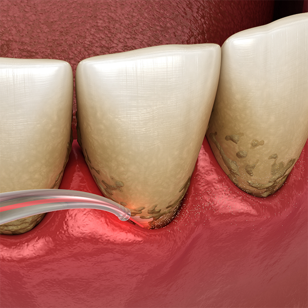 Illustration of laser gum disease treatment