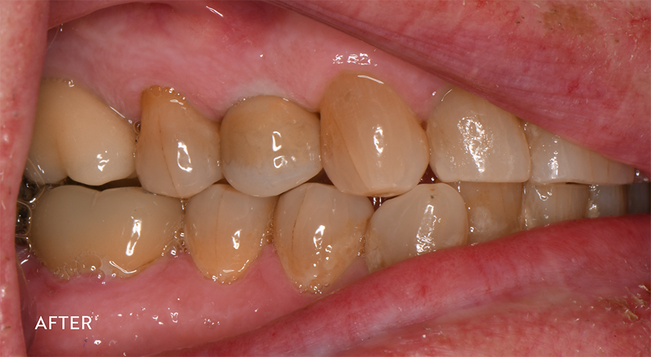 Gap in smile filled with dental implant and custom shaded prosthesis