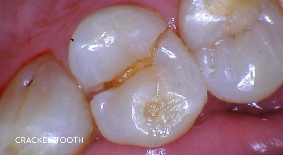 Close up of cracked tooth in mouth