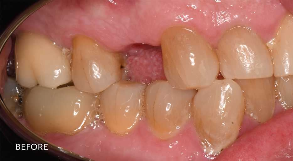 Gap in smile after tooth has been removed