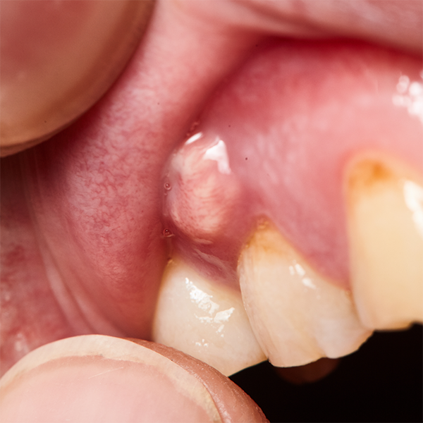 Close up of a bump on the gums
