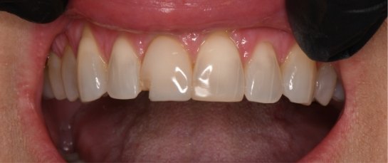 A smile before cosmetic work