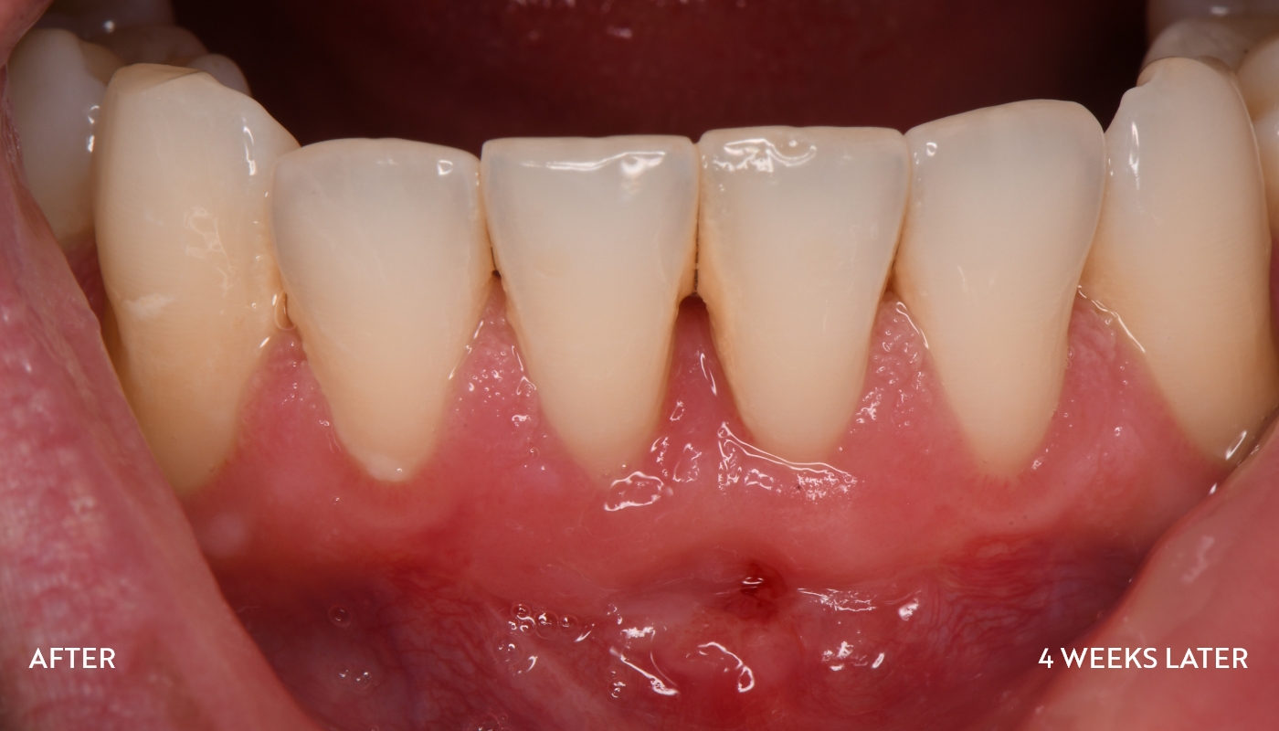Four weeks after gum graft