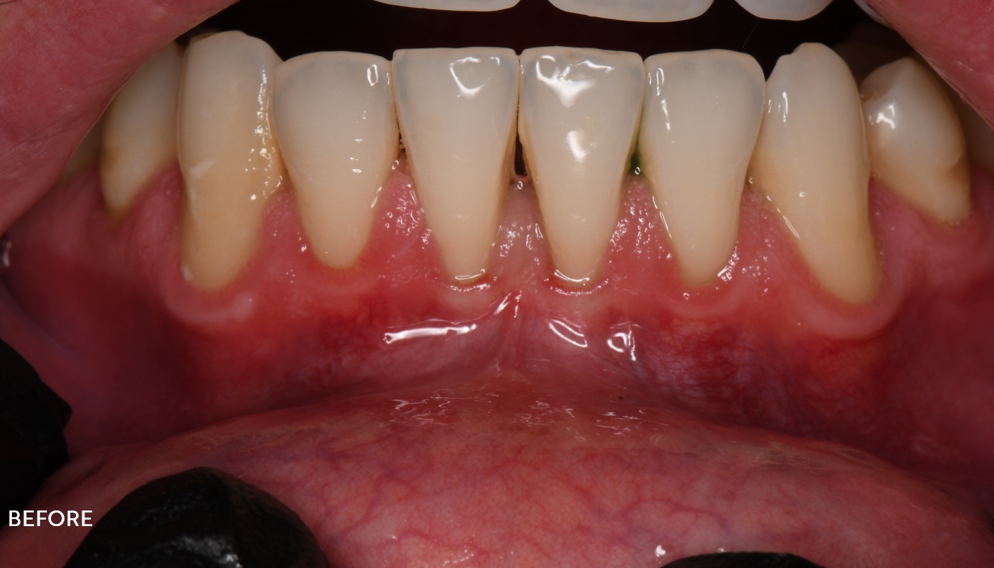 Lower teeth after gum recession