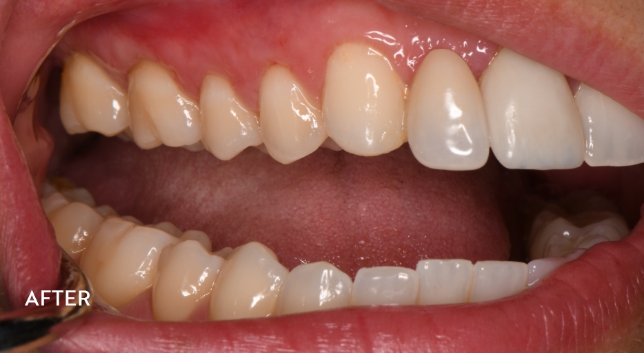 Four weeks after gum graft