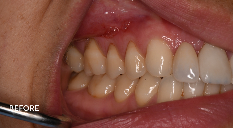 Lower teeth after gum recession