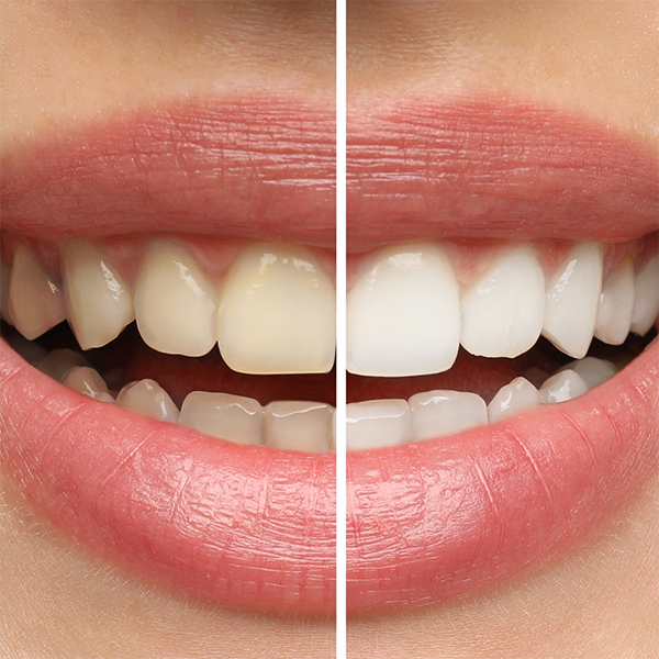 Close-up of a smile before and after teeth whitening in Walnut Creek