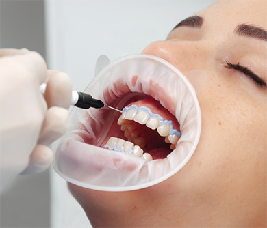 Dental patient getting their teeth whitened