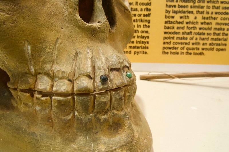 Ancient skull with cosmetic dentistry